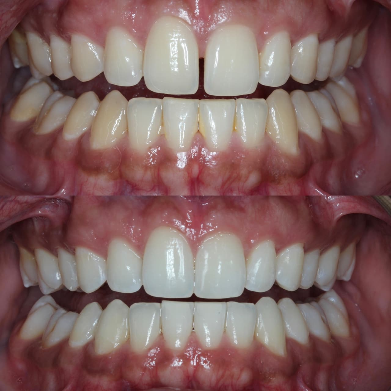 Whitening & Composite bonding