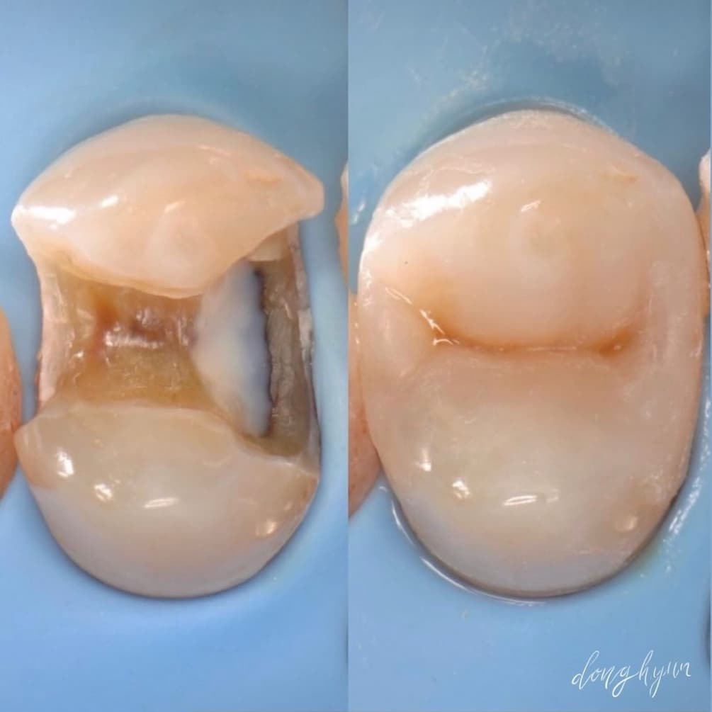 Posterior white filling