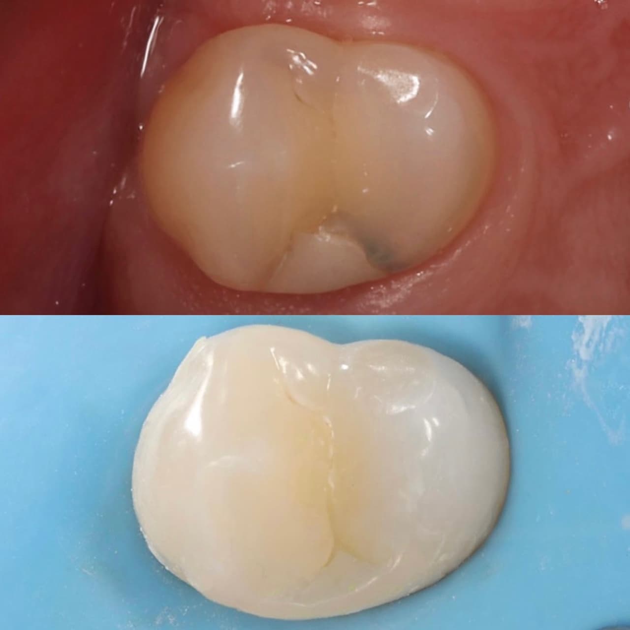 Posterior white filling