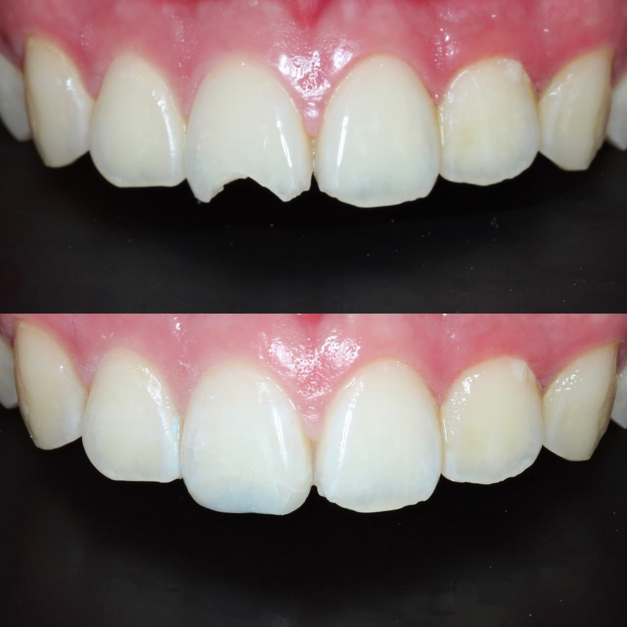 Anterior white filling