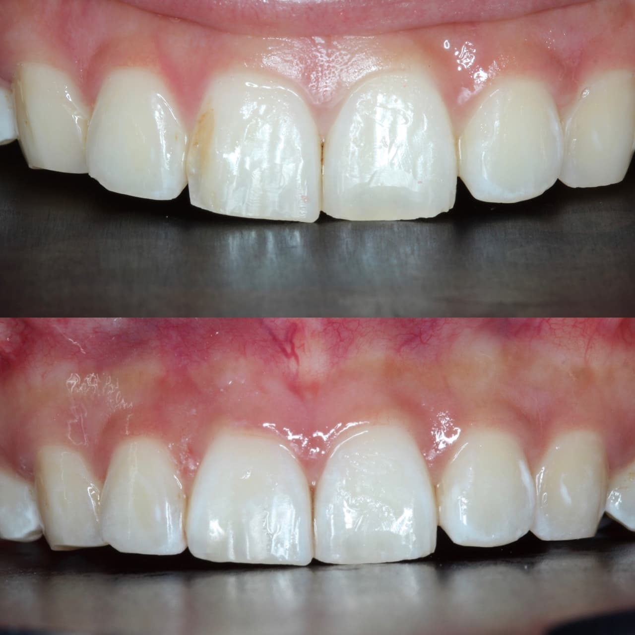 Anterior white filling